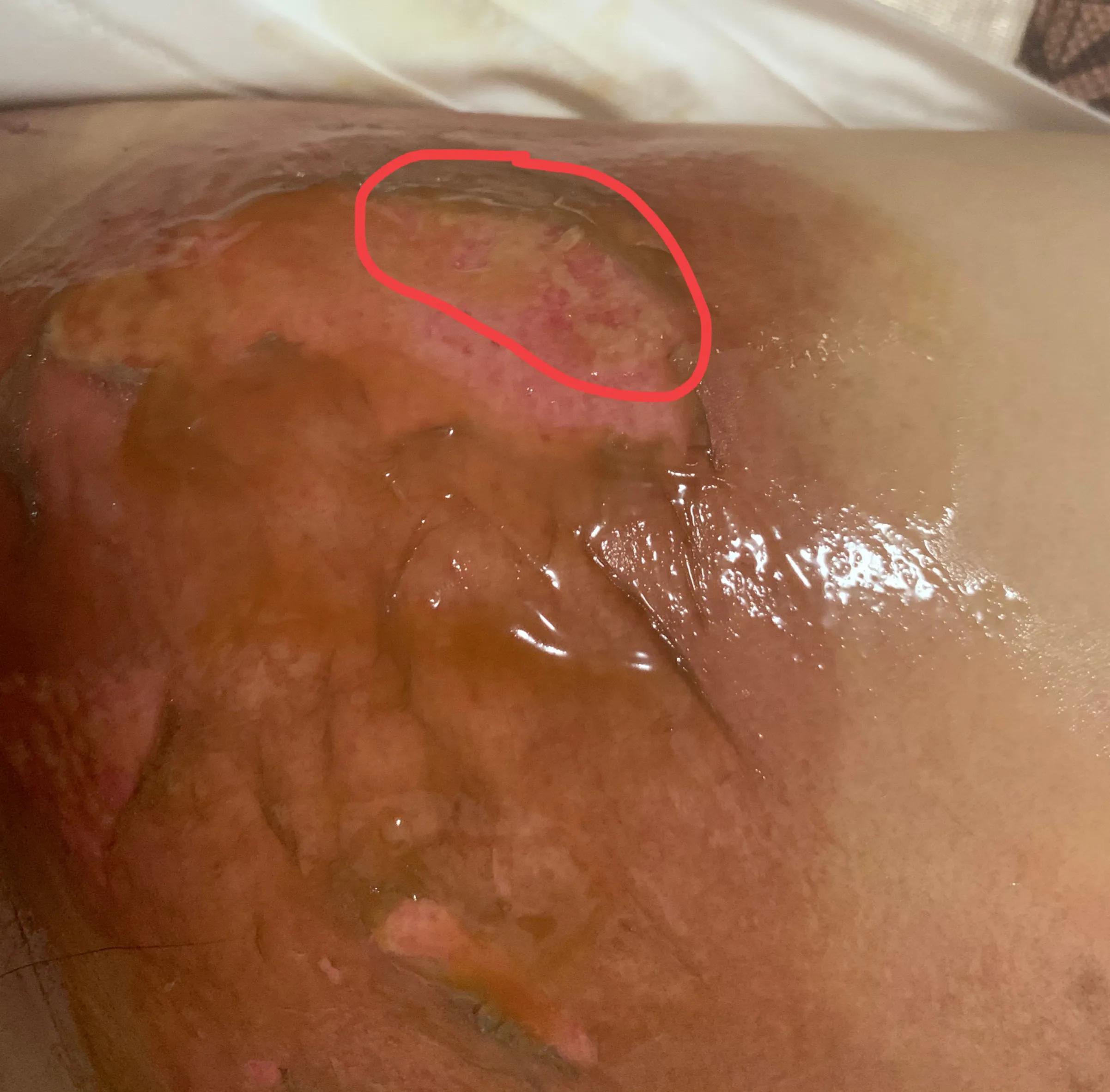 浅二度烫伤14天恢复图片,宝宝浅二度烫伤多久能恢复正常