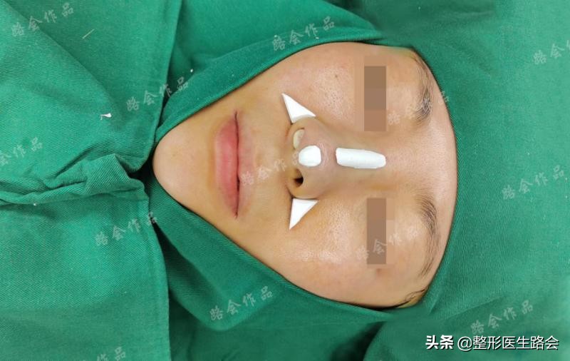 膨体隆鼻3年了鼻尖要露出来,膨体隆鼻会有严重的后果