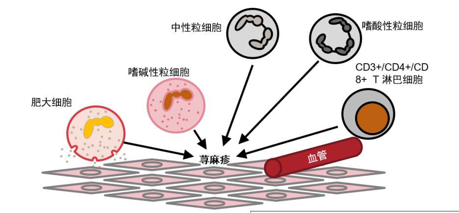 麻疹有什么治疗方法,麻疹和荨麻疹的区别在哪里