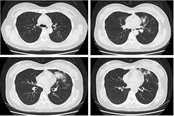 新型冠状病毒肺炎相关知识答疑,新型冠状病毒肺炎必须知道什么