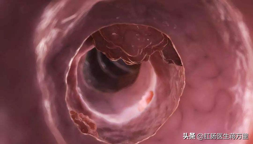 长期便血几年是痔疮还是直肠癌,便血怎么判断是痔疮还是直肠息肉