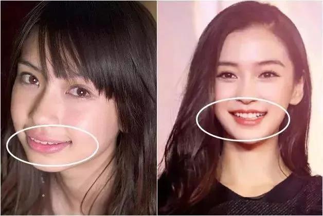 明星整牙前后对比,龅牙明星整牙前后的惊人变化