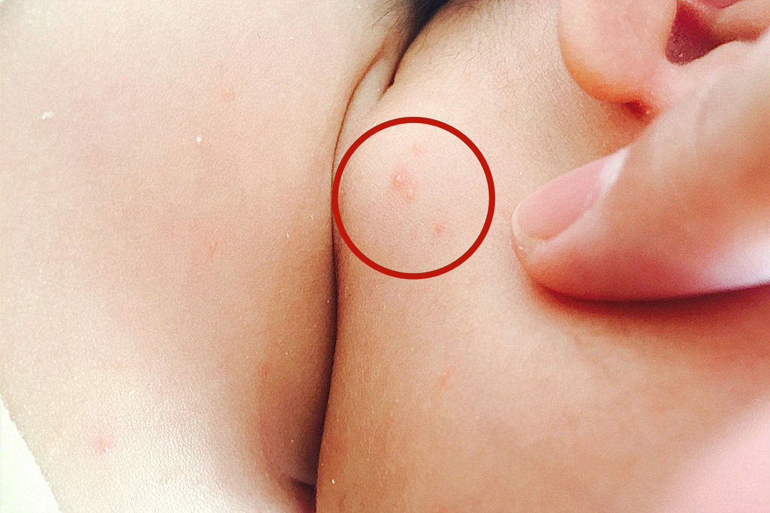 宝宝身上长湿疹还有点红点,小孩身上痱子和湿疹区别