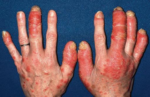 银屑病是什么样的病症,银屑病是免疫系统疾病