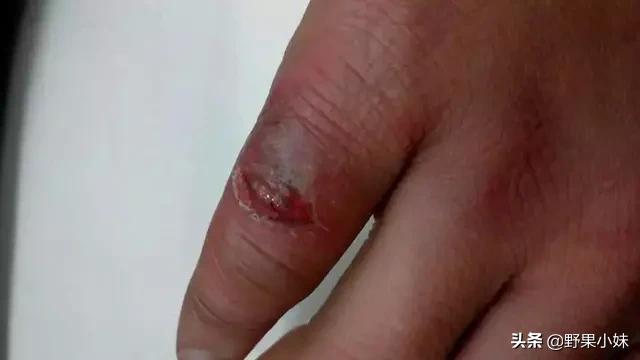 冻疮是怎么形成的原因是什么,冻疮严重溃烂的怎么治