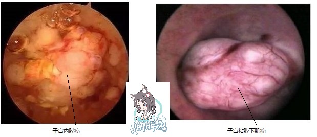 宫腔镜片子一般有几个图像,不学医的话懂看诊流程吗