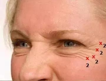 鱼尾纹的注射点和进针方法,鱼尾纹注射深还是浅