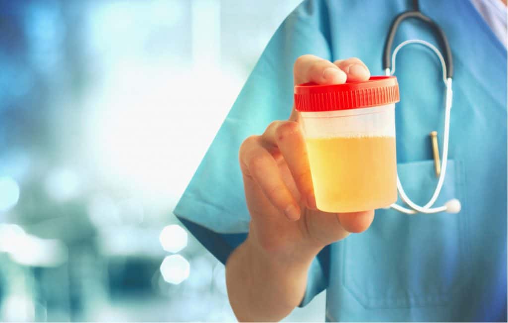 尿糖和糖尿病的区别,尿糖数值多少是糖尿病