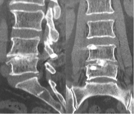 大姐腰椎间盘突出，陈明博士微创治疗，你信吗？