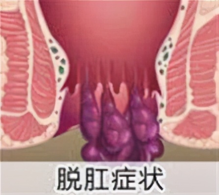 直肠脱垂会自己恢复吗,直肠脱垂怎么能自行恢复