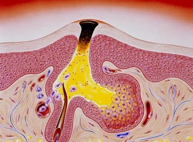 细盐去黑头最好的方法,新手推荐用什么酸去黑头