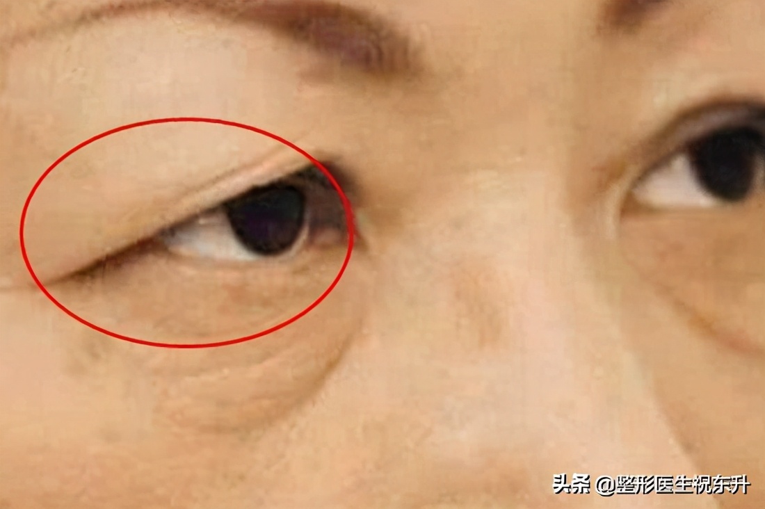 上睑皮肤松弛矫正案例,上睑皮肤松弛下垂解决方法