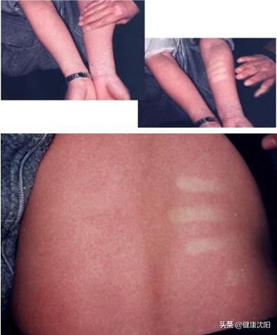 猩红热防控知识,呼吸道健康科普