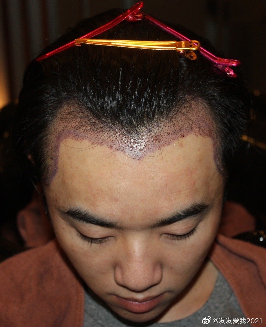 我证明：纯情少年华晨宇真的没有整容没有植发没有情人没有私生子