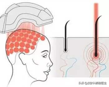 雄激素性脱发的中医认识,雄激素性脱发怎么诊断