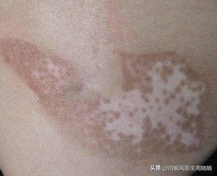 脸上的白斑长得好快是什么原因,脸上有不规则的白斑是什么