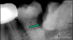 别让一颗牙齿毁了一张脸?医生说95%的人都有这样的牙齿!