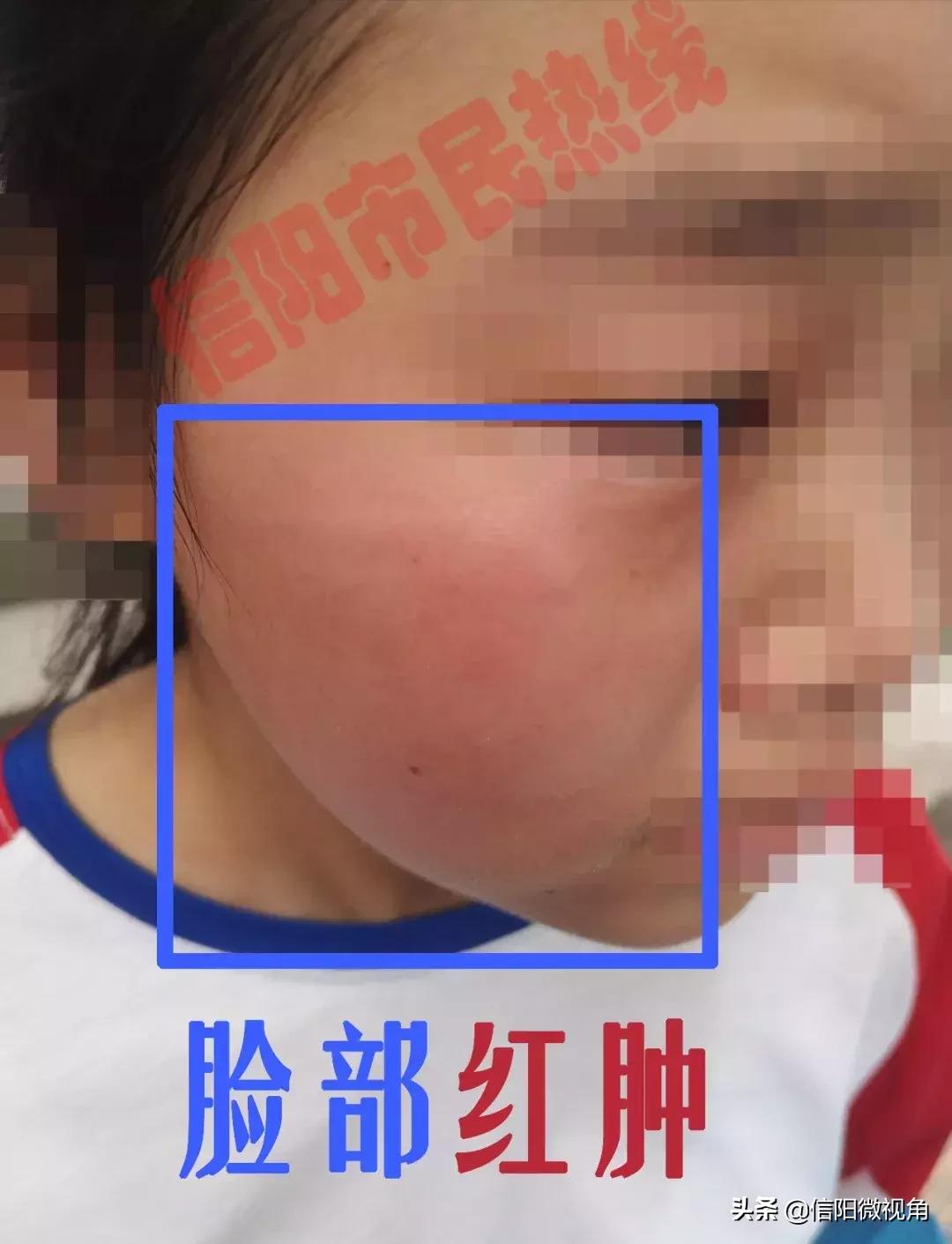 八岁女童被老师打致残,8岁女童被老师打残