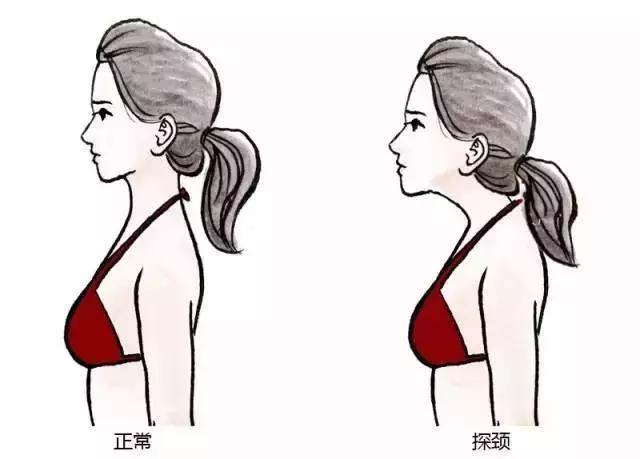 怎么能让脖子变美,猥琐颈能矫正吗