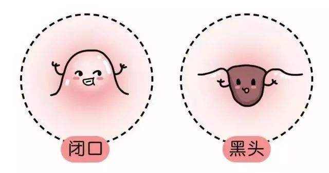 管不住自己的手老是挤痘痘,管不住手喜欢挤痘痘