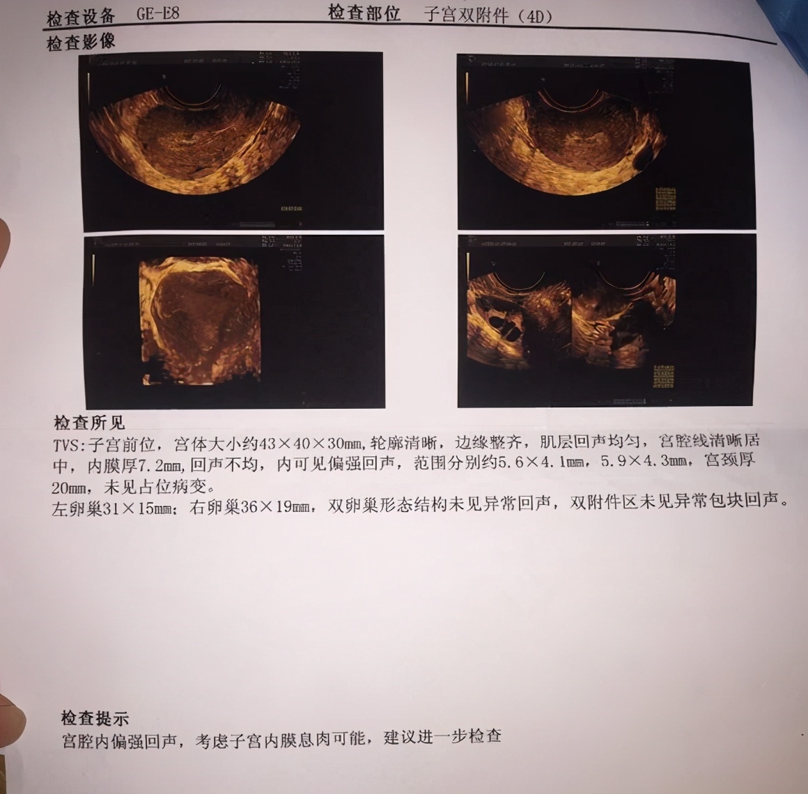 肌瘤和子宫内膜息肉都可以怀孕吗,多发性子宫内膜息肉可以怀孕吗