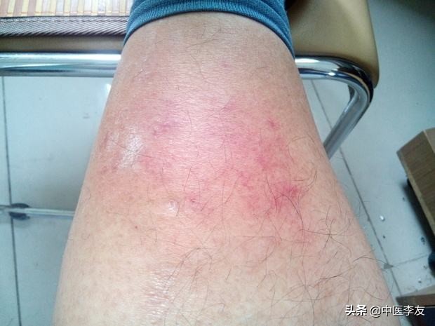 针灸过程中病症加重是什么原因,针灸异常情况的处理