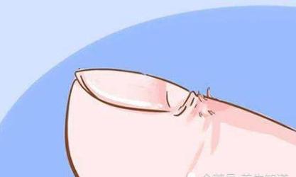 手指倒刺甲沟炎的症状及图片,手指甲沟炎是不是异物引起的