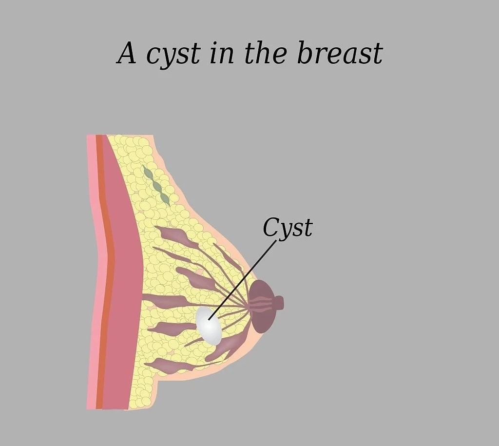 乳腺囊肿导致乳房阵阵刺痛,乳腺增生乳房有囊肿怎么治疗