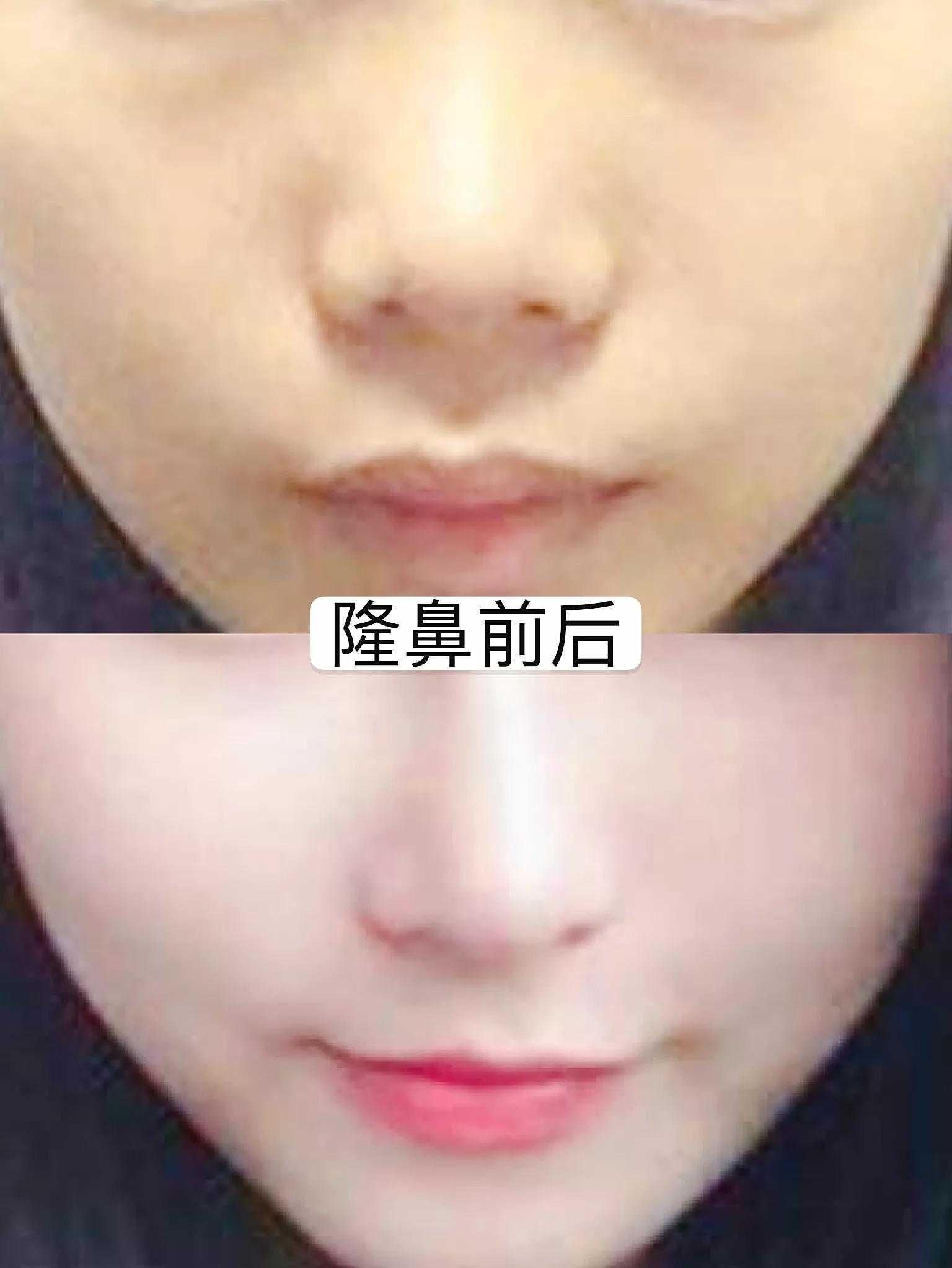 假体隆鼻后5天鼻尖发红,假体隆鼻三年后鼻尖发红