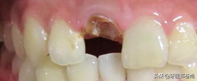 蛀牙已经烂空了只剩下牙根多少钱,蛀牙补好后牙根疼怎么办