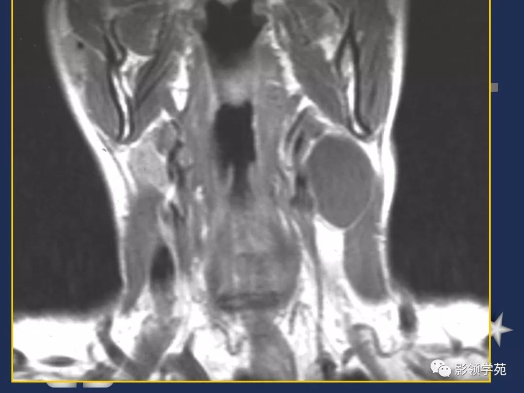 腮腺疾病影像学诊断,腮腺肿块影像诊断