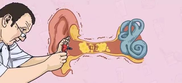 耳朵里老有耳屎一挖就出血,耳朵里面有耳屎能不能挖