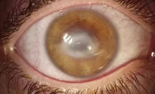 戴隐形眼镜导致角膜损伤,戴隐形眼镜的安全隐患