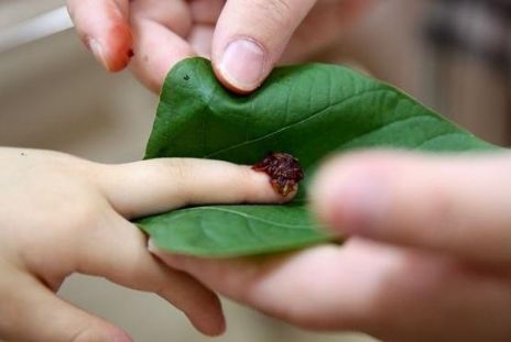 灰指甲治不好？如何防治顽固的皮肤真菌，关键三要素注意一下