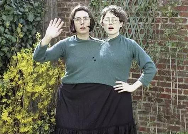 连体人一个死了另一个咋办,连体人去世另一个人有什么后果