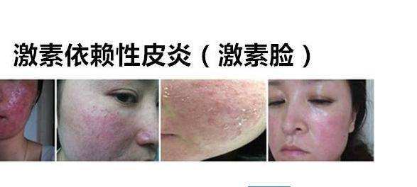 激素脸好难受,激素脸痒的难耐怎么办