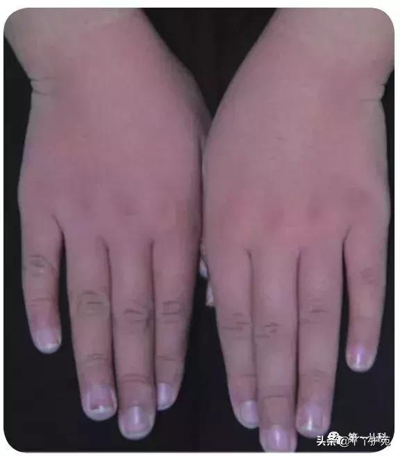 手足口病水痘荨麻疹有什么区别,麻疹水痘手足口病皮疹的区别