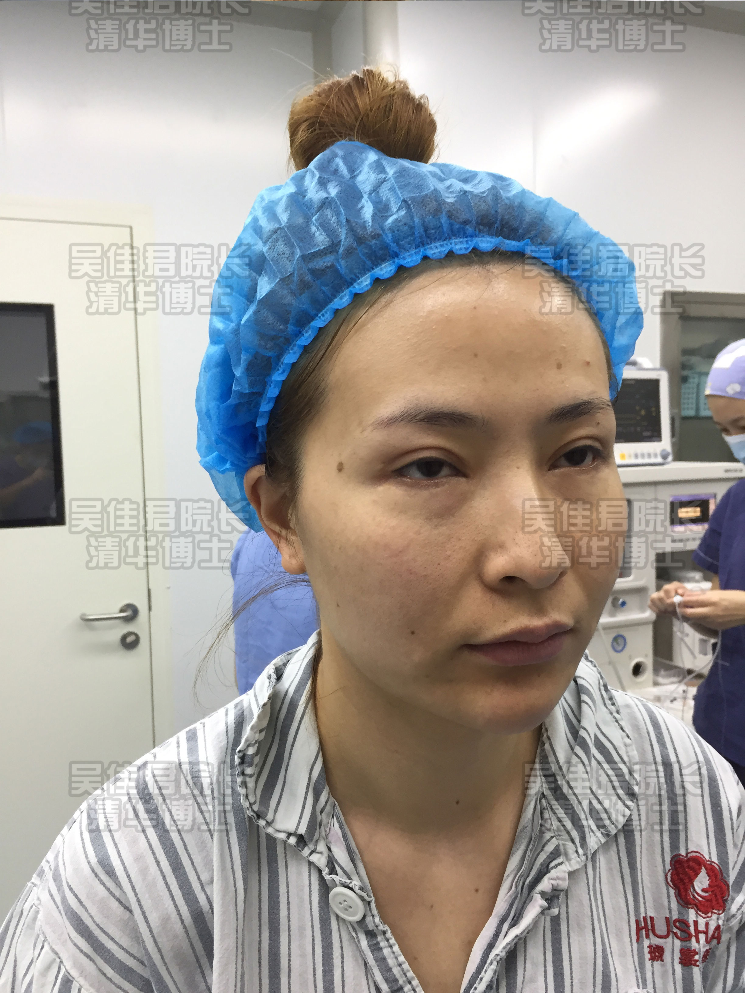 小拉皮手术后真实感受,小拉皮手术后的真实案例