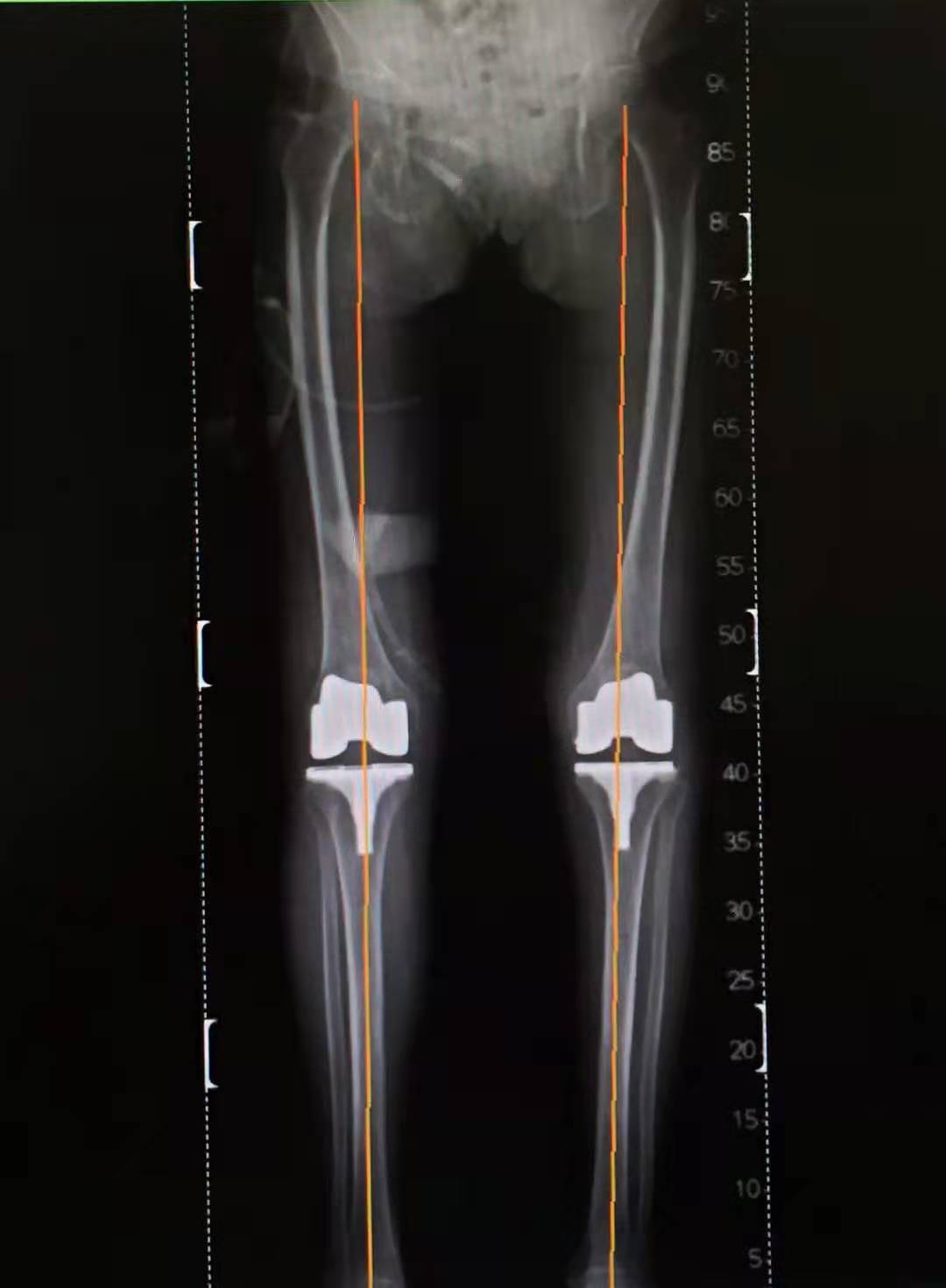 双膝功能障碍患者通过TKA手术重获行走功能