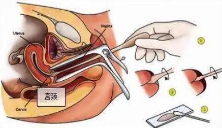 阴道镜检查宫颈癌症状,做宫颈癌筛查什么情况下需要活检