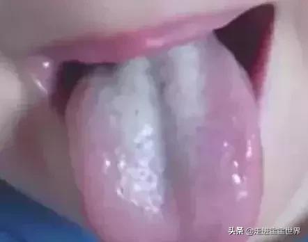 小儿积食舌苔白厚吃啥药,舌苔又厚又黄是湿气太重吗