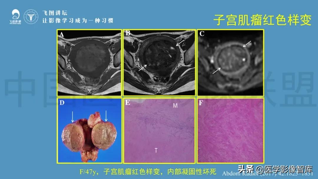 子宫解剖结构输卵管和卵巢位置,子宫附件ct影像学正常解剖表现