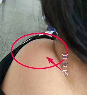 脖子上有富贵包怎么消除,脖子上面长了富贵包应该怎么消除