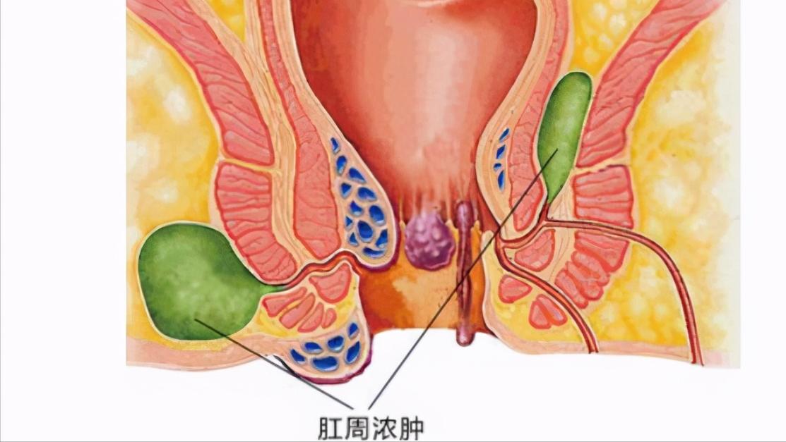 肛门瘙痒像虫爬是怎么回事,肛门瘙痒像有虫在爬