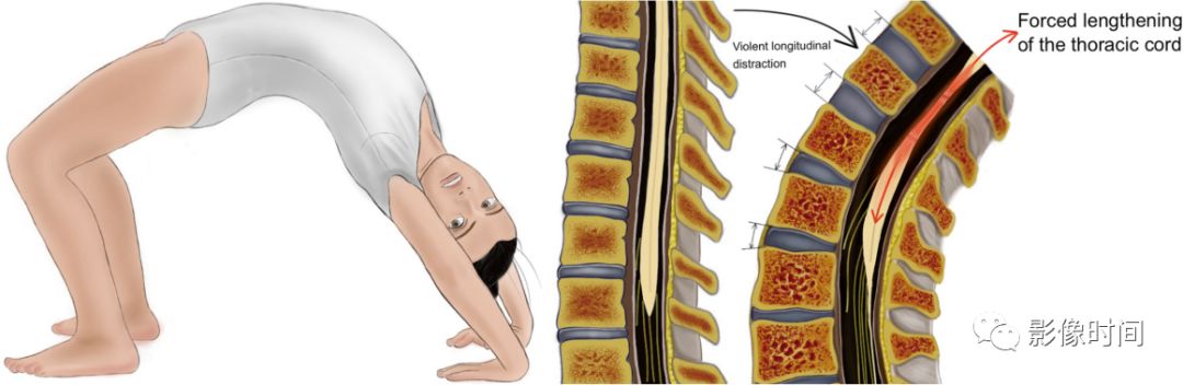脊髓病变案例图文问诊,脊髓病变视频