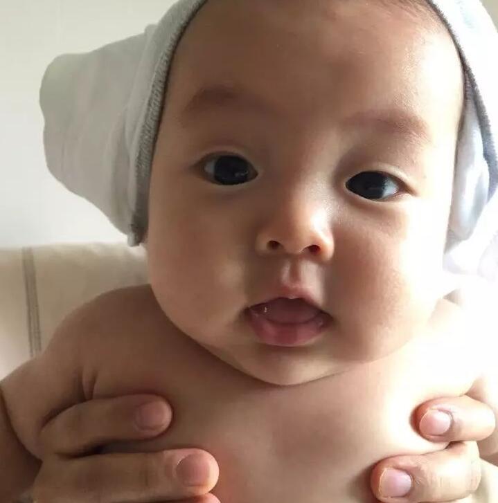 顺产锁骨骨折需要治疗吗,顺产锁骨骨折的宝宝日常怎么护理