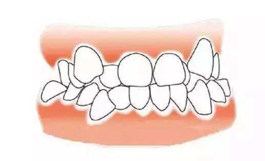 成年后牙齿矫正一般需要多少钱,牙齿矫正大概要花费多少钱成年人