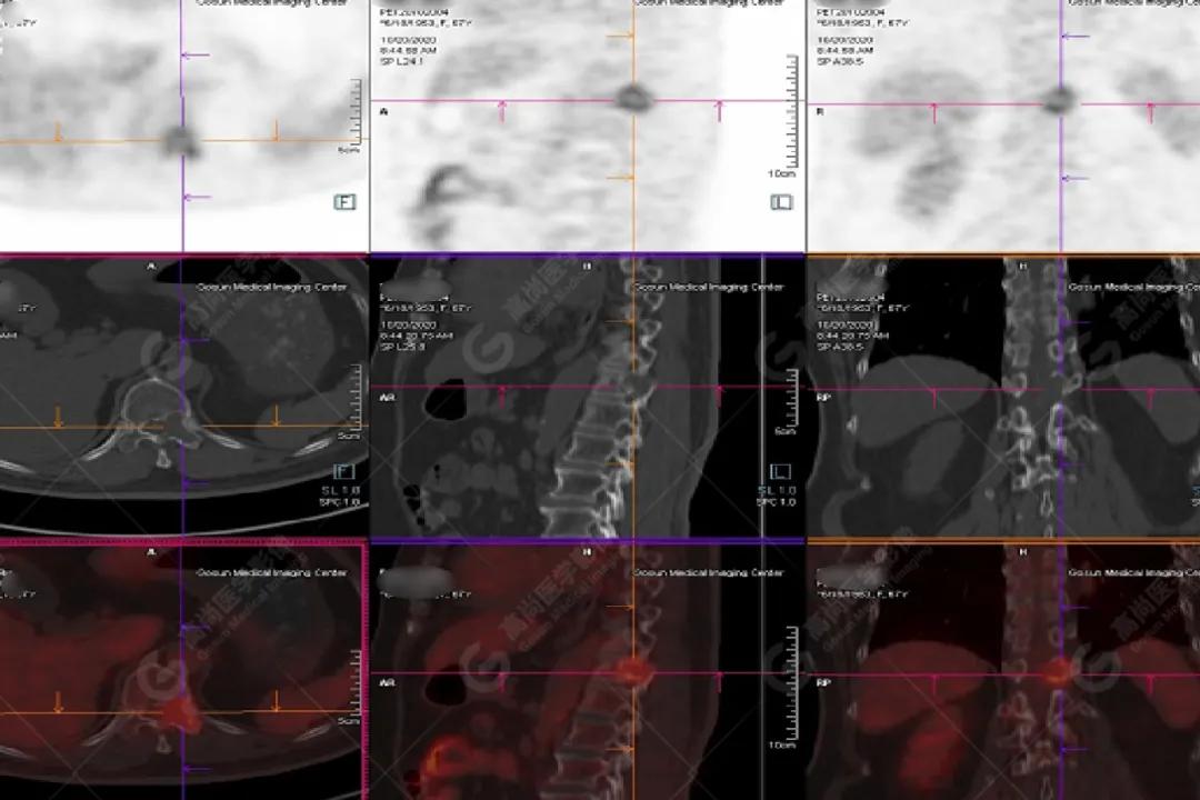 女性防癌检查科普,妇女宫颈癌及乳腺癌筛查情况年报