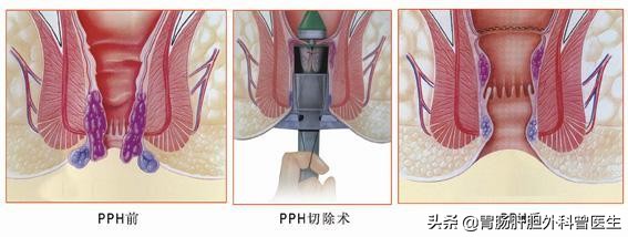 痔疮脱垂用什么药最好,得了脱垂痔疮一定要做手术吗