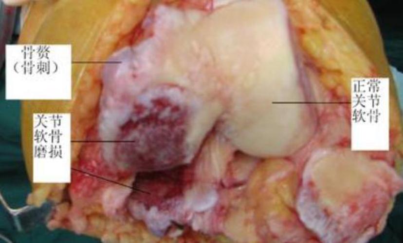 老年人骨性关节炎膝盖疼怎样锻炼,老年人膝关节骨关节炎首选检查